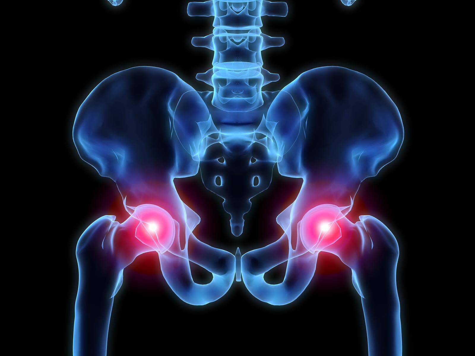 Physio For Osteoarthritis Of The Hip Upwell Health