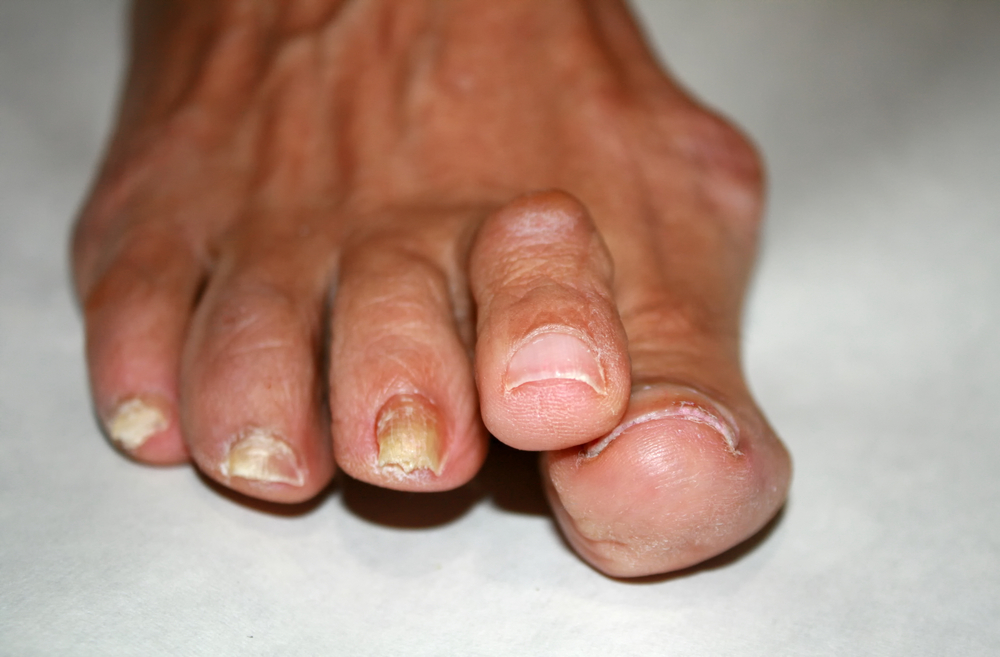 Podiatrist Osteoarthritis In Foot And Ankle